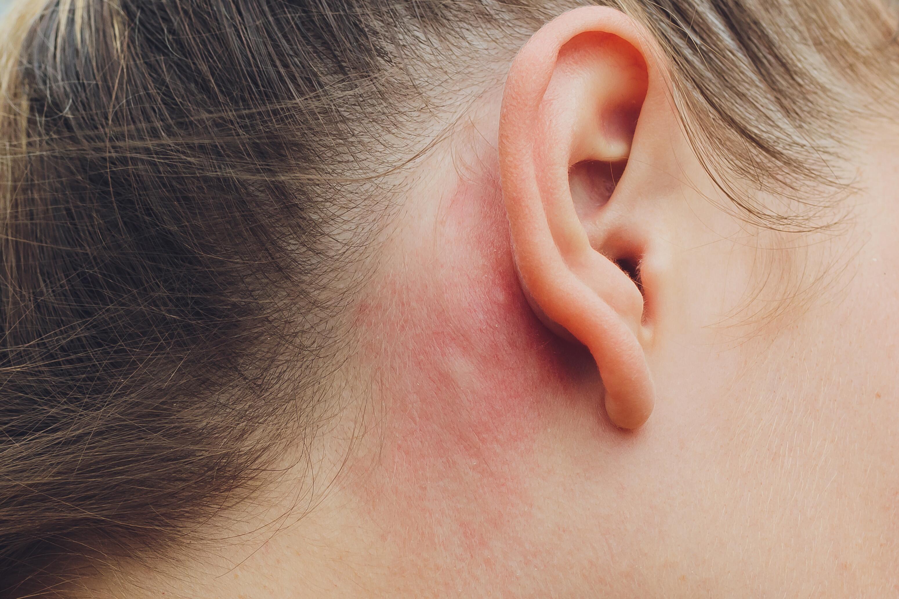 AD_website_eczema ears_symptoms_2025